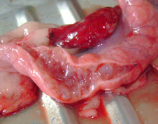 Hiperplasia endometrial