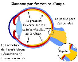 Glaucome à angle fermé