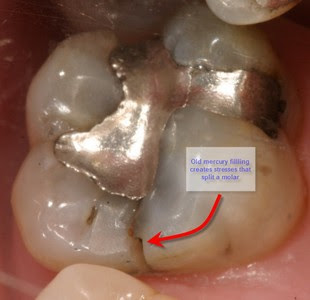 very small crack in tooth