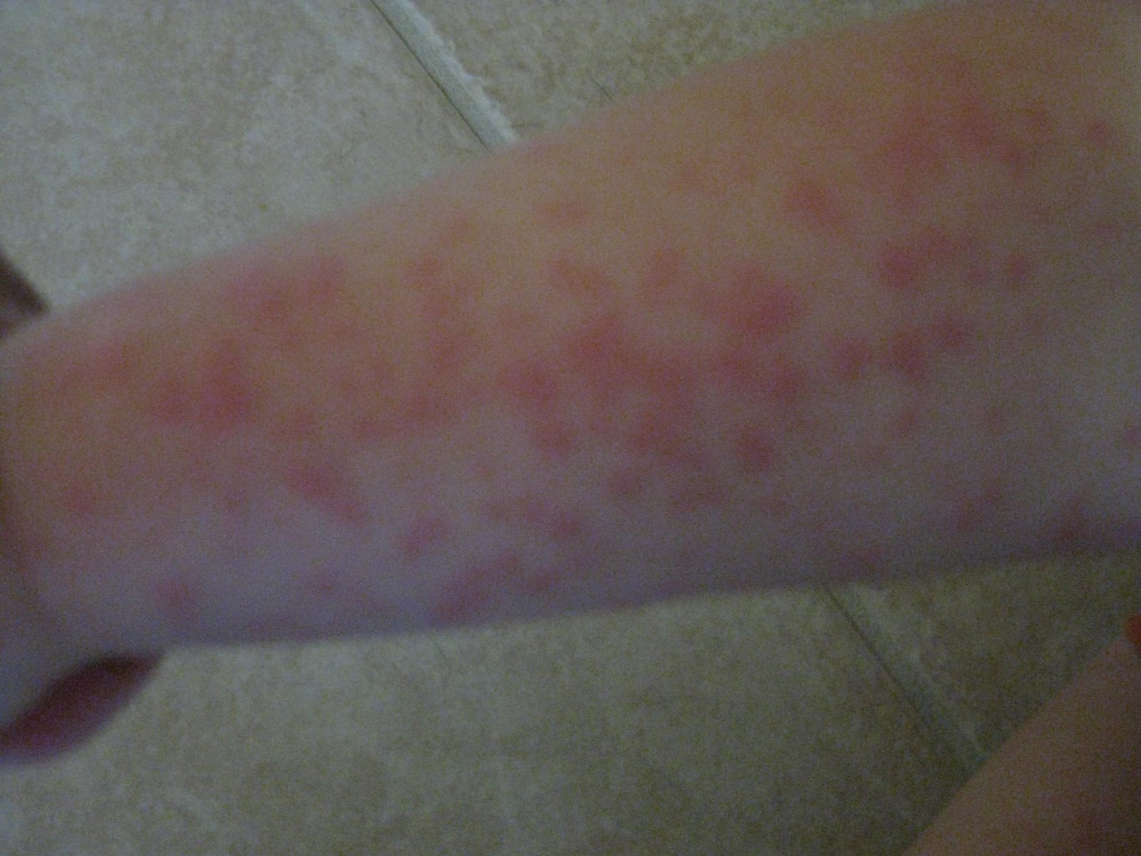[Baby+Rash2.BMP]