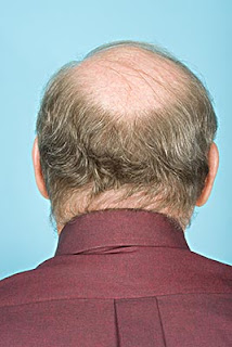 禿頭 雄性禿 禿頭原因 預防禿頭 禿頭治療