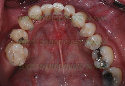 retainers attivi retainers attivi
