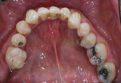 retainer passivo retainer passivo