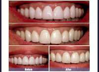 Cheap Teeth Whitening
