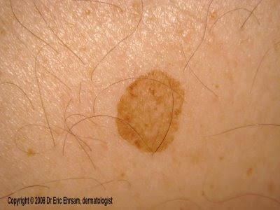 heat rash on legs. have heat rash on legs. heat rash on legs. have