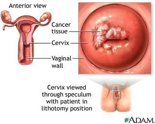 gambar kanser serviks