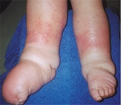 Lymphedema of the leg: Diagnostic image Foot Swelling Foot Lymphedema