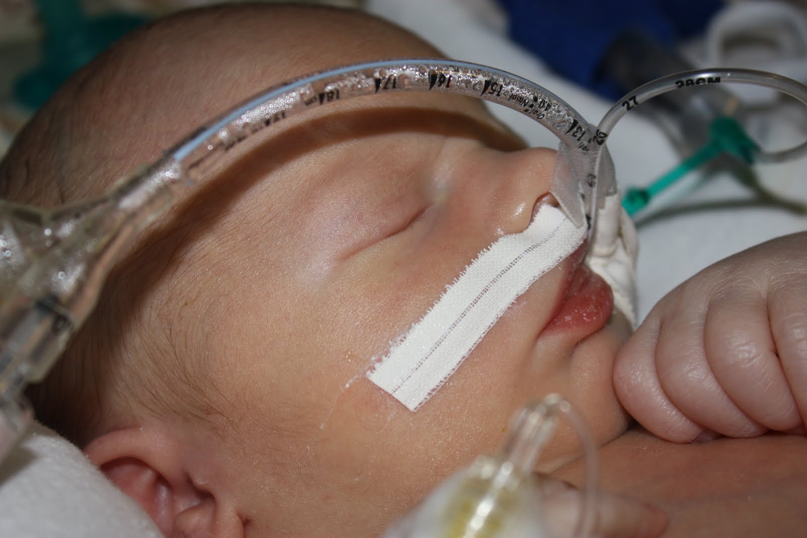 Brenchley's Blog The NICU