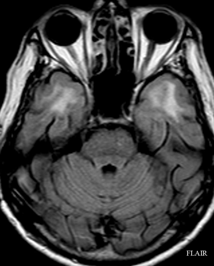 Fractured Kneecap Symptoms CASE 71 : 65 year-old woman with dementia-4.bp.blogspot.com