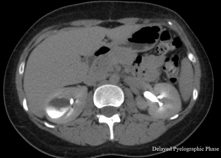 Caliceal Diverticulum