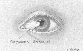 Indikasi kortikosteroid topikal pada mata