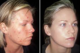 38+ Benzoyl Peroxide Before And After Acne Background