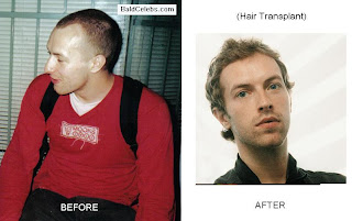 BaldCelebs.com: Chris Martin ( musician ) Status: Receding Hairline