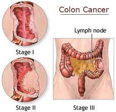 Colon Cancer Symptoms Photos