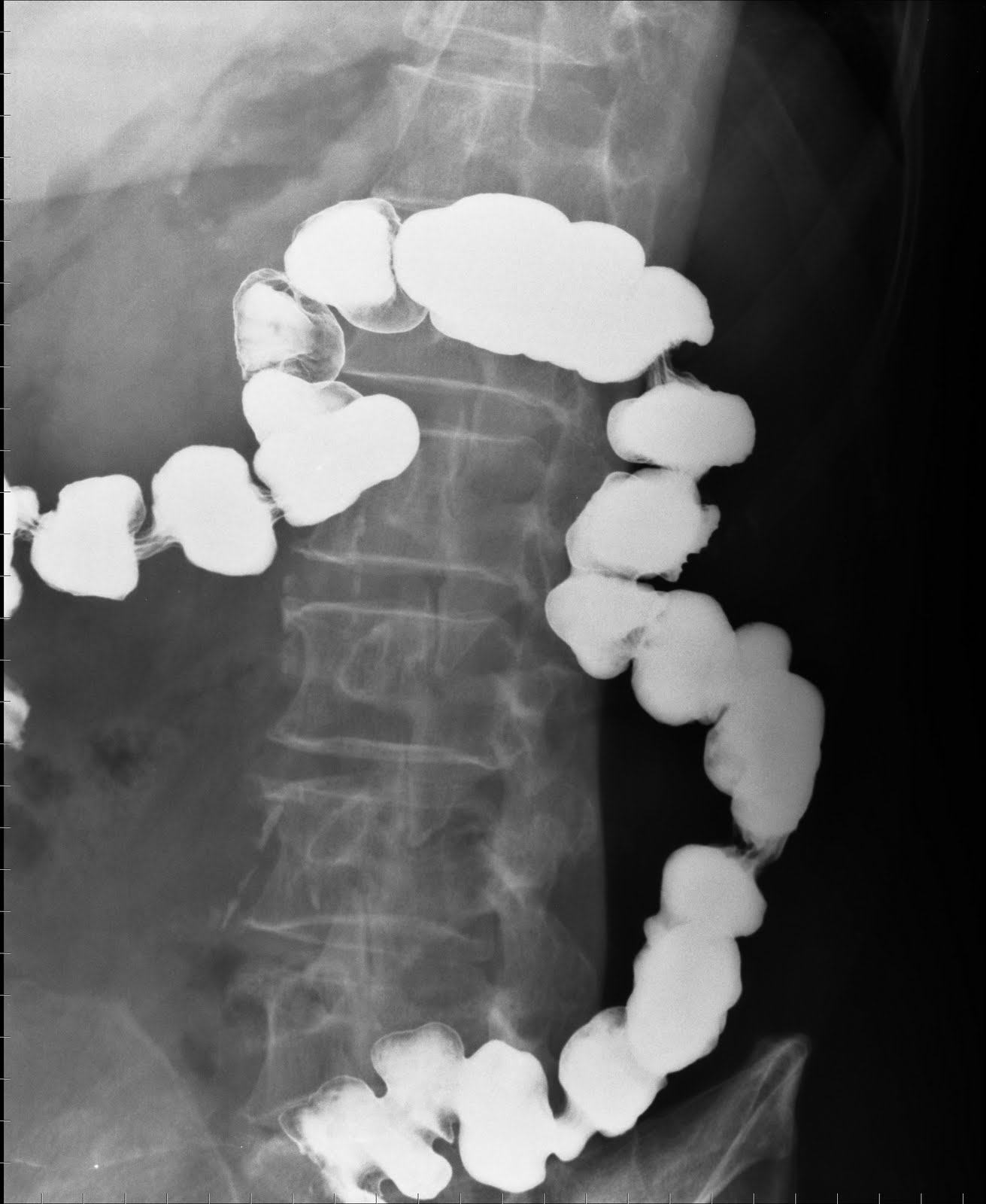 Cafe Radiologi Teknik Pemeriksaan Kontras "Colon In Loop"