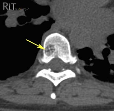 RiT radiology: Spinal Hemangioma