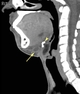 Cyst Near Base Of Cat S Tail Cyst Near Base Of Cat S Tail
