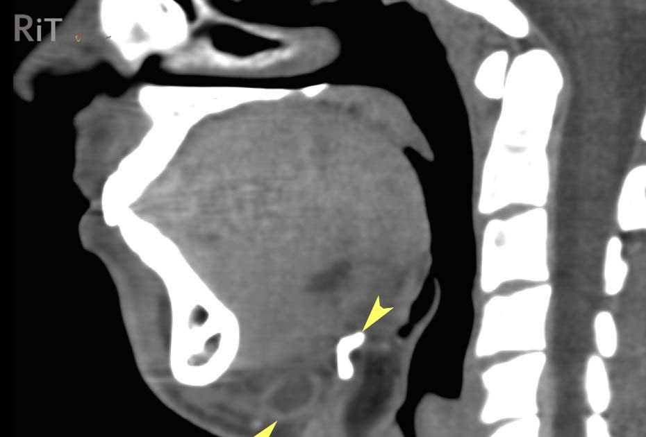 RiT radiology Thyroglossal Duct Cyst