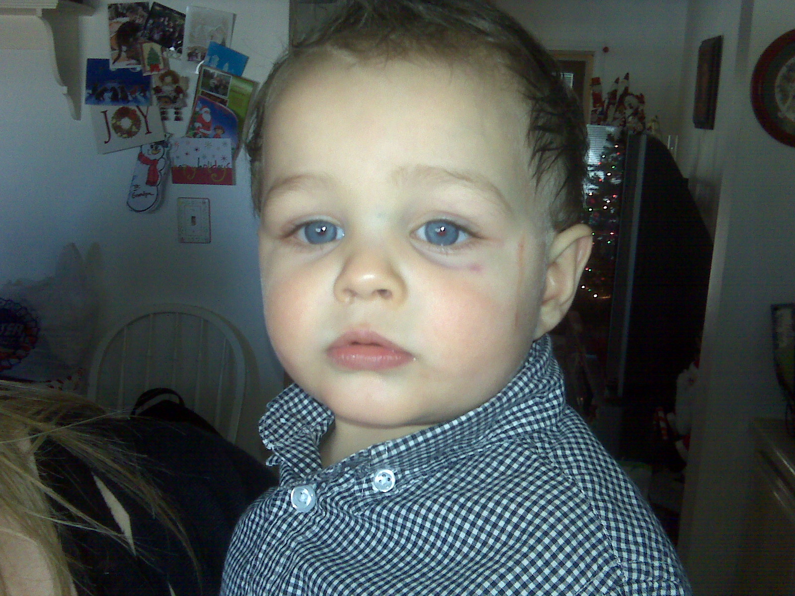 Matching Black Eyes Tell Me How you Got That Black Eye...PLEEEEEEEEEASE?