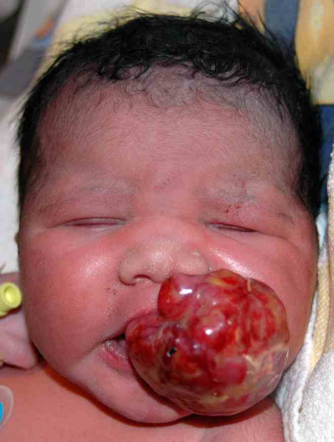 EMBARAZO LEUCEMIA embarazo leucemia: