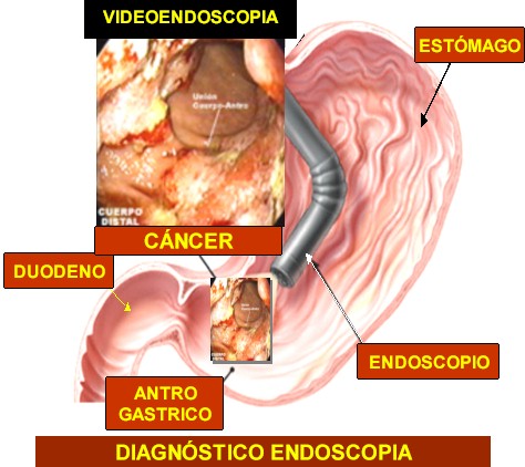 Bioquímica do Câncer: Adenocarcinoma gástrico