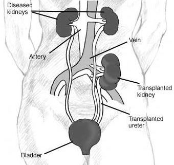 [Kidtransplant.jpg]