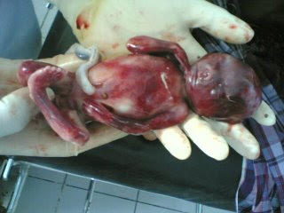 Pengertian Aborsi