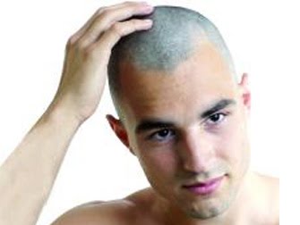 alopecia alopecia
