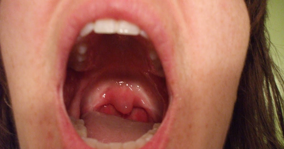 As Simple As It Sounds My Swollen Uvula