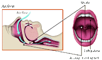 Uvulopalatopharyngoplasty Before