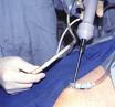 Ultrasound Assisted Liposuction