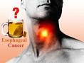 Esophageal Cancer