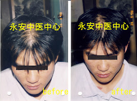 治疗脱发