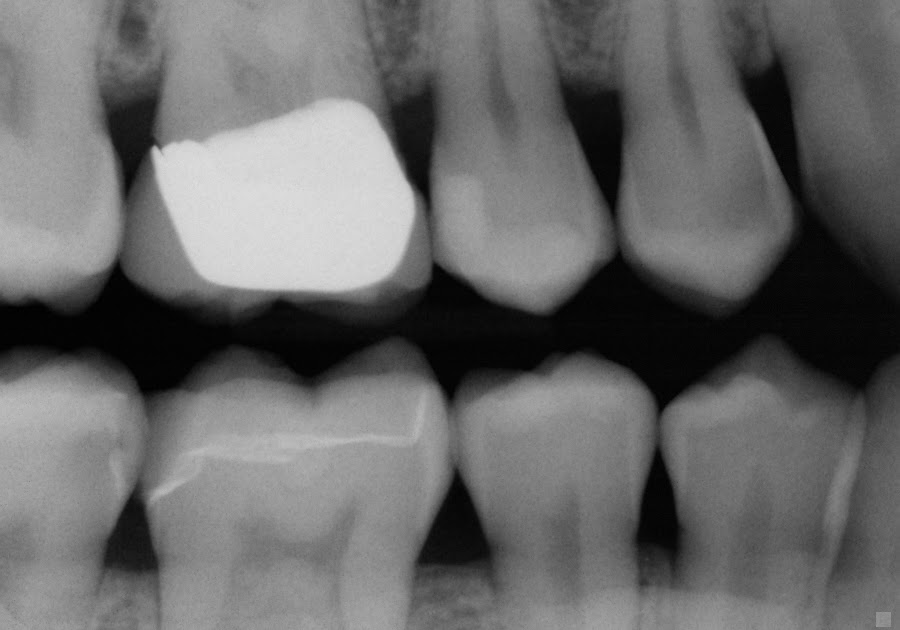 James Mahooti DDS Tooth decay under crowns. What is leakage? How