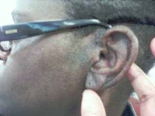 Lupus Ear
