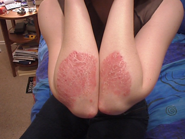El ácido salicílico de que ayuda la psoriasis