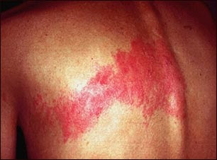 herpes zoster essay shingles herpes zoster essay shingles