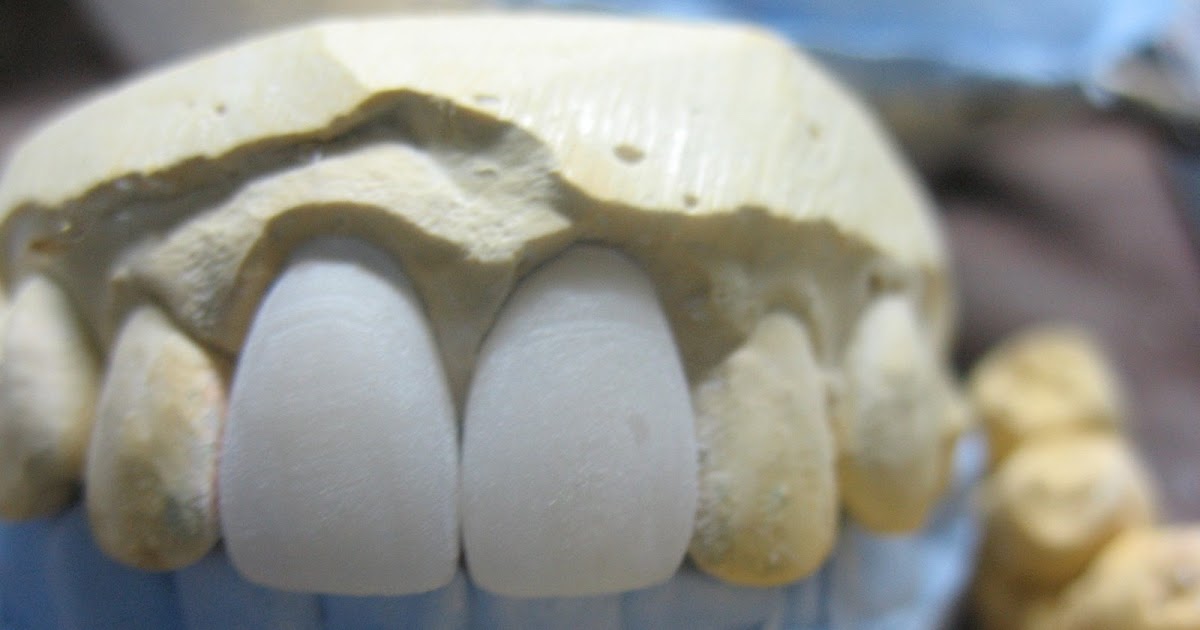 DENTCERAMIC Coronas Jacket de porcelana