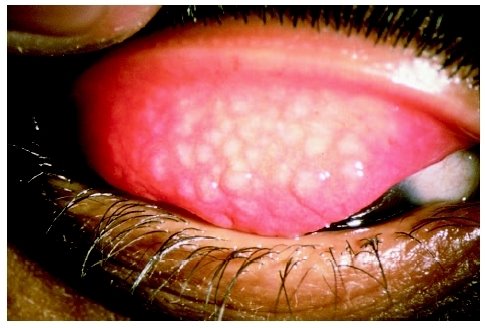 [trachoma.jpg]