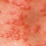 [Scabies.jpg]