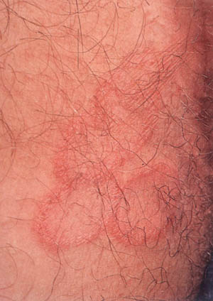 [Ringworm2.jpg]