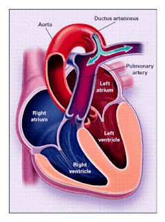 Patent ductus arteriosus treatment