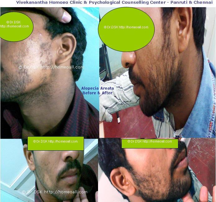 [Alopecia+Areata++(9).JPG]