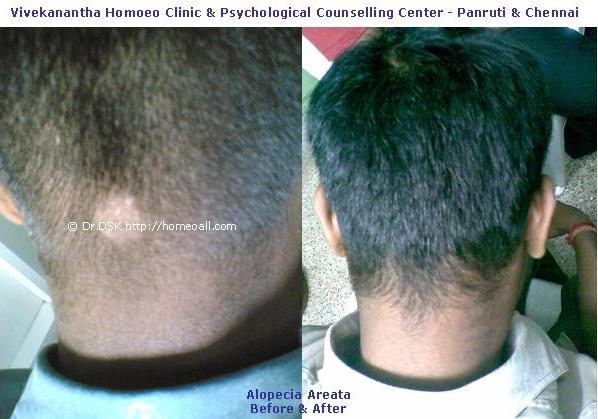 [Alopecia+Areata++(12).JPG]