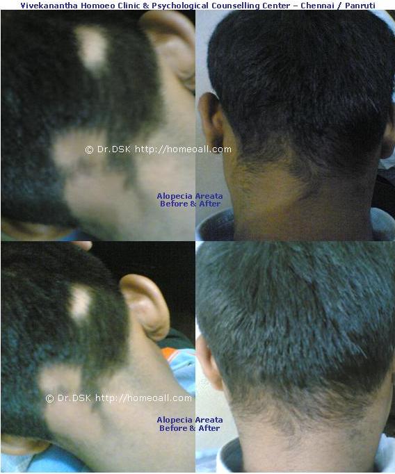 [Alopecia+Areata++(4).JPG]