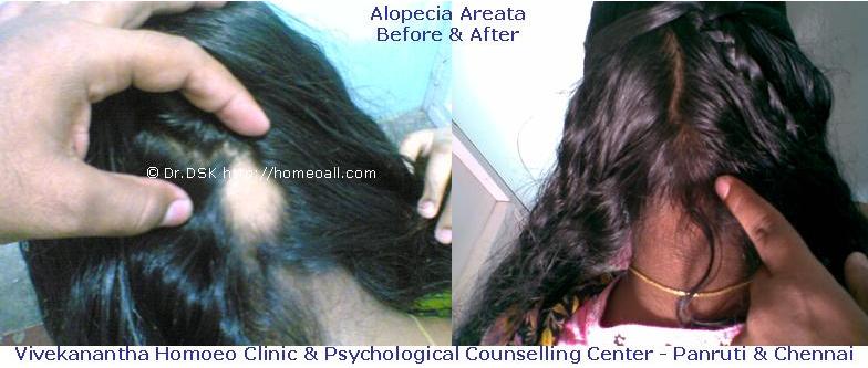 [Alopecia+Areata++(3).JPG]
