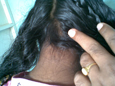 Alopecia Areate- AfterTreatment