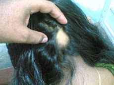 Alopecia Areate- Before Treatment