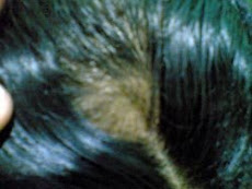 Alopecia Areate- During  Treatment