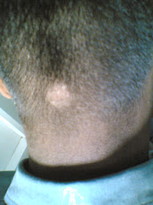 Alopecia Areate- BeforeTreatment